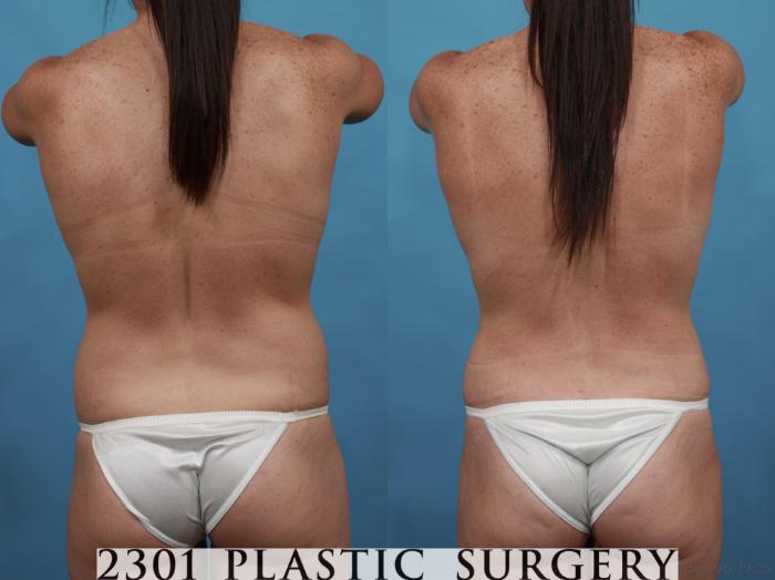 Before & After Mommy Makeover Case 568 View #6 View in Fort Worth & Frisco, Texas
