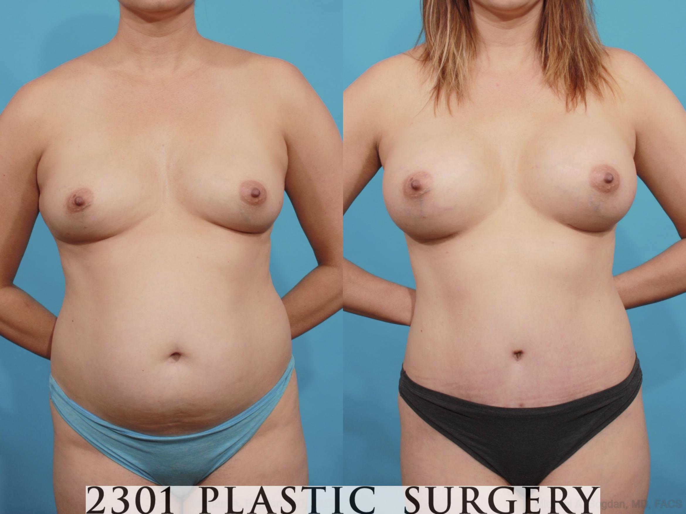 Before & After Mommy Makeover Case 570 View #1 View in Fort Worth & Frisco, Texas