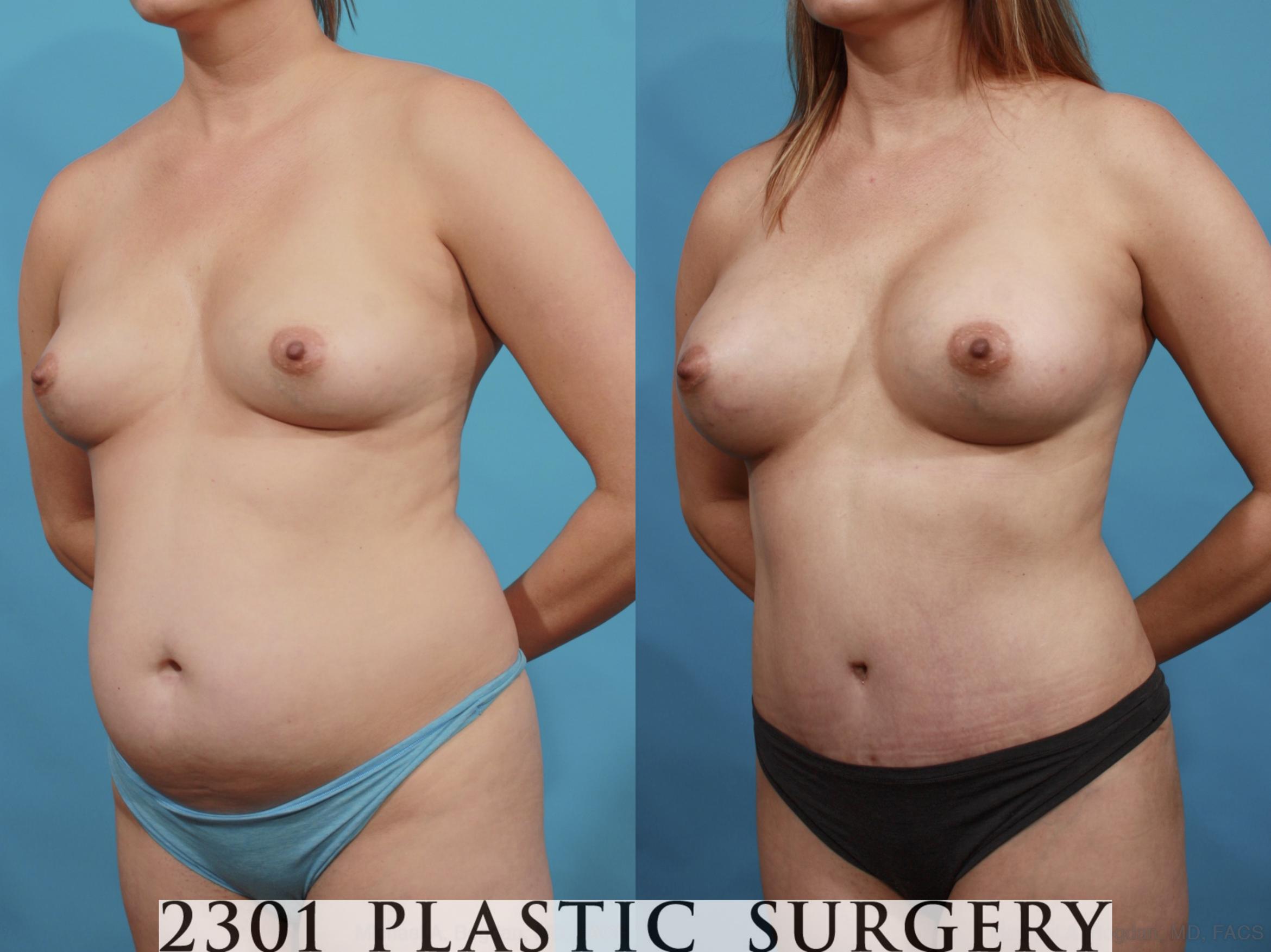 Before & After Mommy Makeover Case 570 View #2 View in Fort Worth & Frisco, Texas