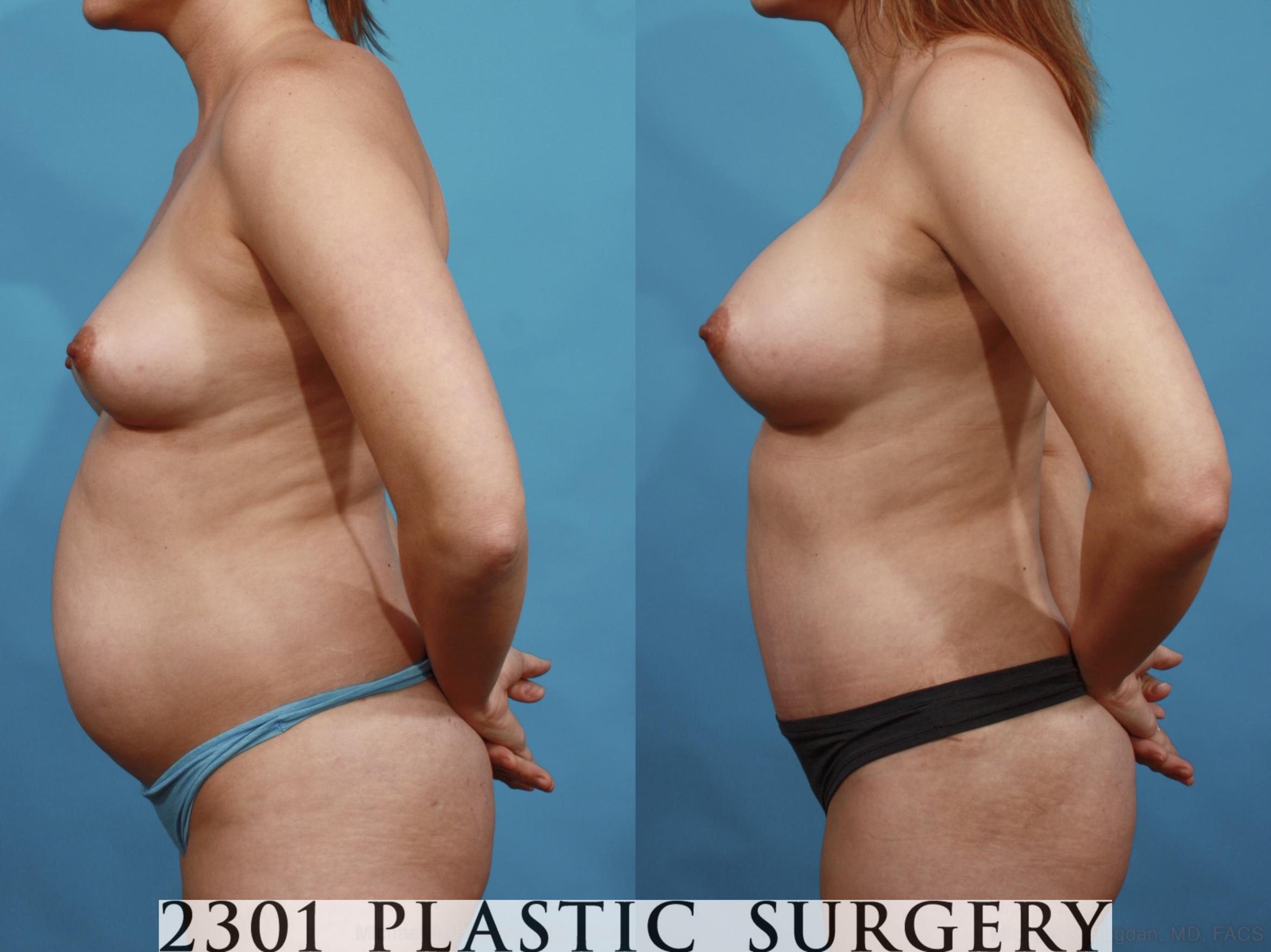 Before & After Mommy Makeover Case 570 View #3 View in Fort Worth & Frisco, Texas