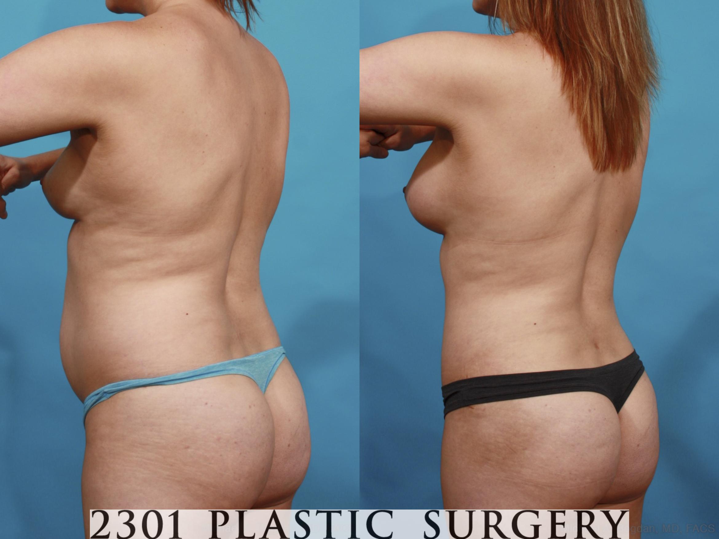 Before & After Mommy Makeover Case 570 View #4 View in Fort Worth & Frisco, Texas