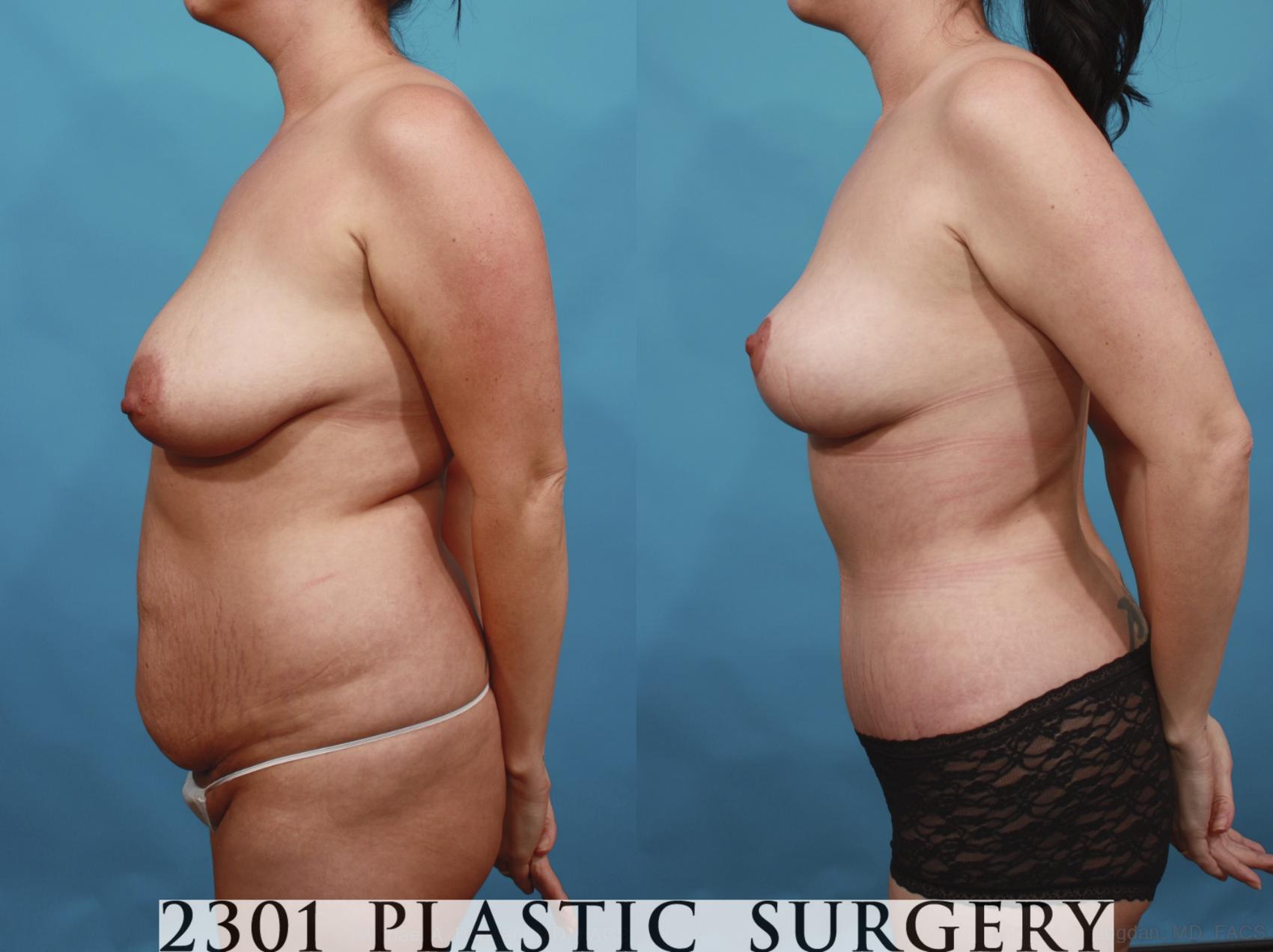 Before & After Mommy Makeover Case 591 View #3 View in Fort Worth & Frisco, Texas