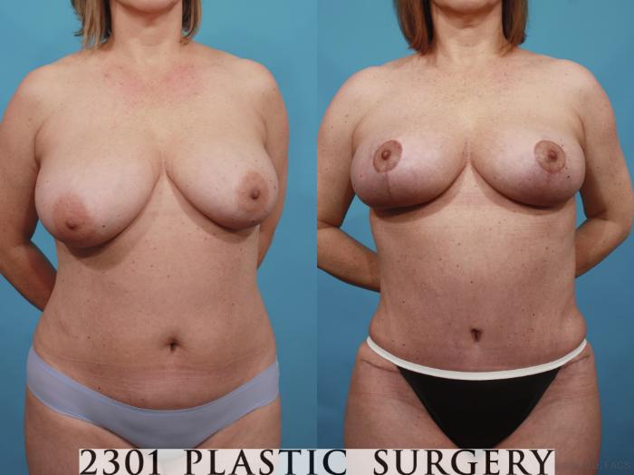 Before & After Breast Lift (Mastopexy) Case 592 View #1 View in Fort Worth, Plano, & Frisco, Texas