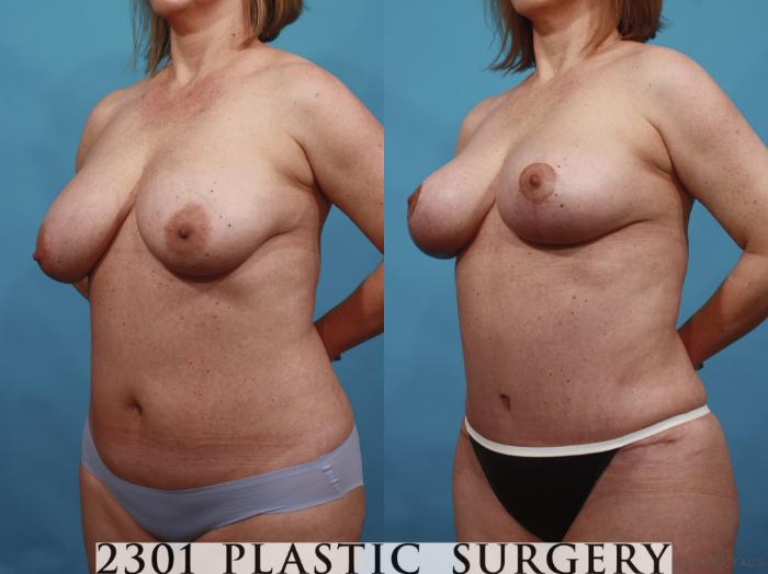 Before & After Breast Lift (Mastopexy) Case 592 View #2 View in Fort Worth, Plano, & Frisco, Texas