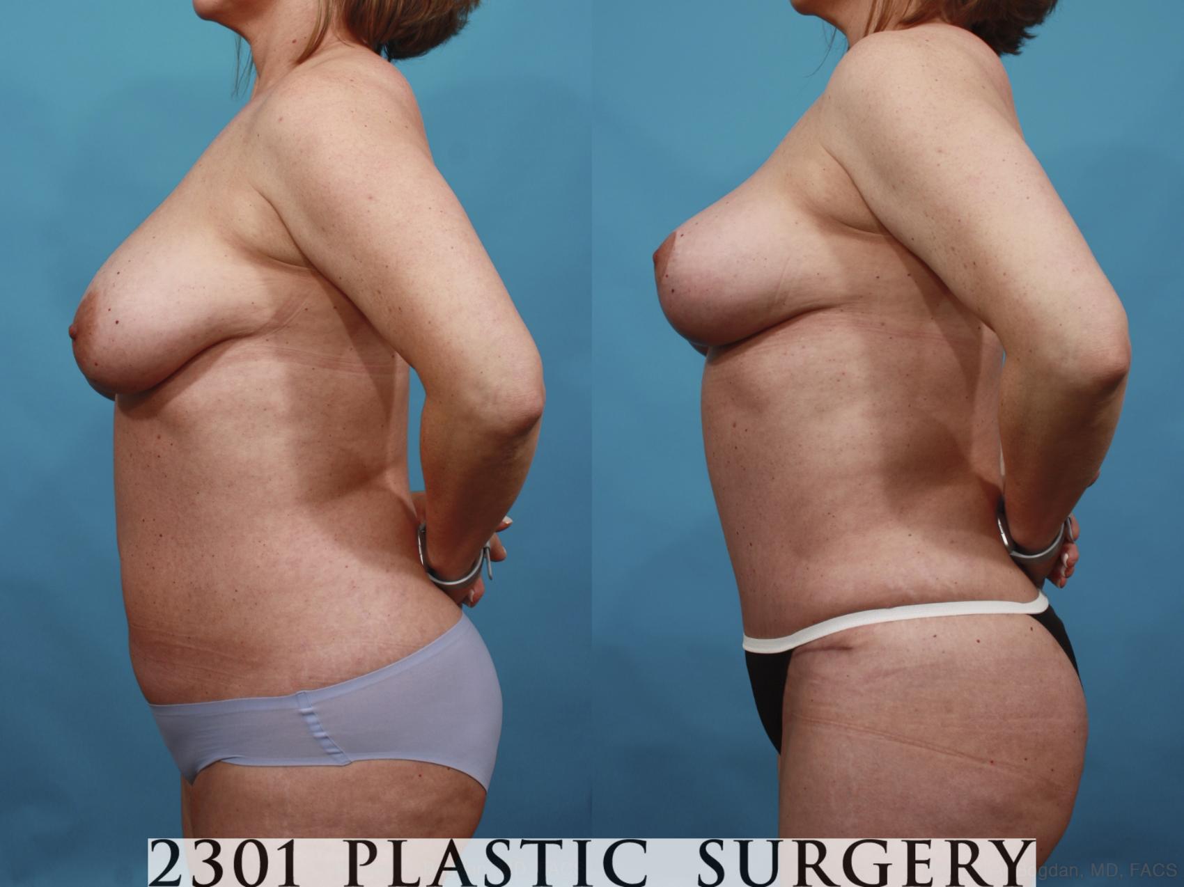 Before & After Mommy Makeover Case 592 View #3 View in Fort Worth & Frisco, Texas
