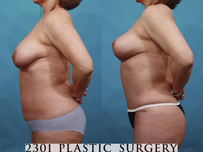 Before & After Tummy Tuck Case 592 View #3 View in Fort Worth, Plano, & Frisco, Texas