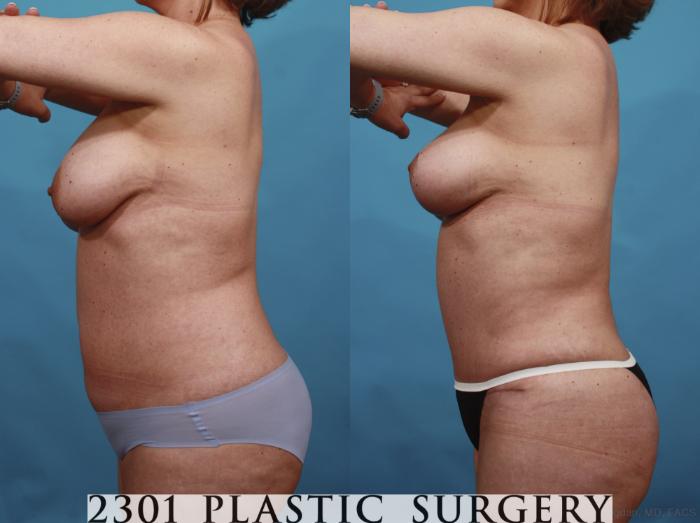Before & After Breast Lift (Mastopexy) Case 592 View #4 View in Fort Worth, Plano, & Frisco, Texas