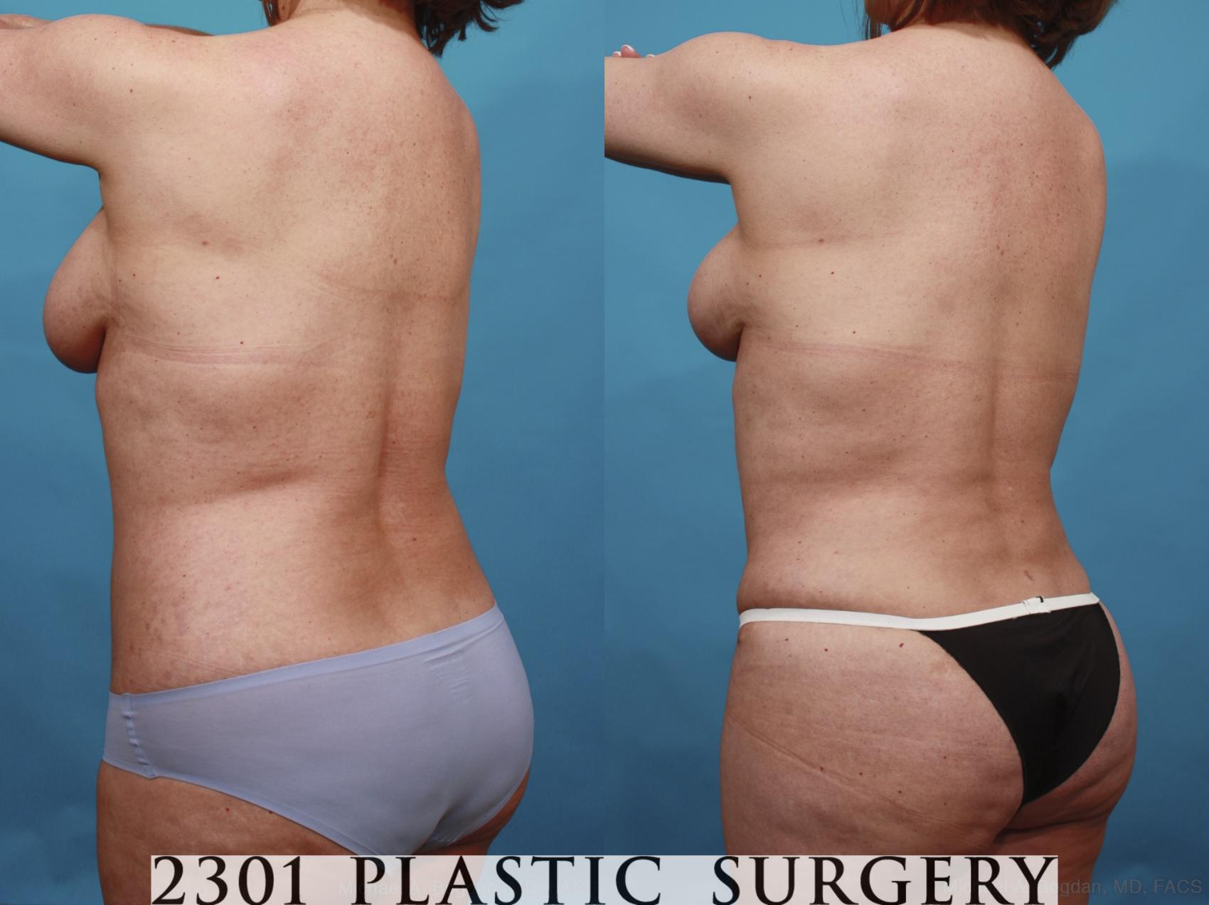 Before & After Mommy Makeover Case 592 View #5 View in Fort Worth & Frisco, Texas