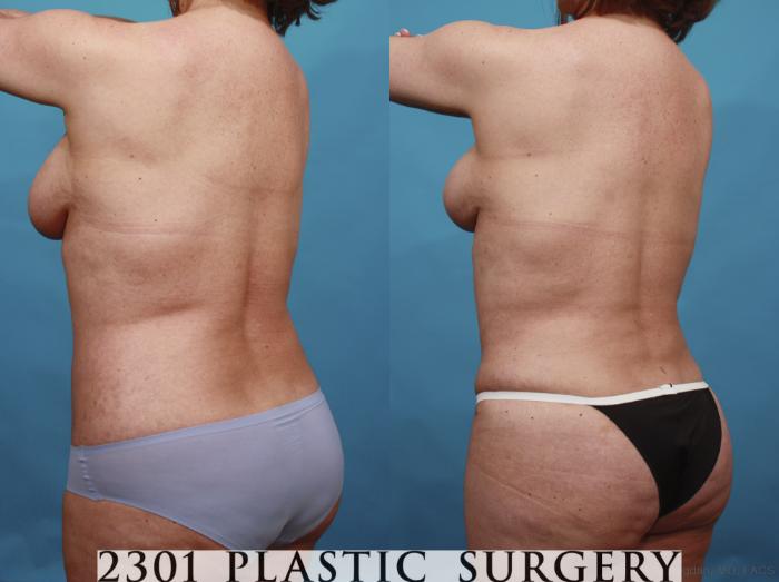 Before & After Tummy Tuck Case 592 View #5 View in Fort Worth, Plano, & Frisco, Texas
