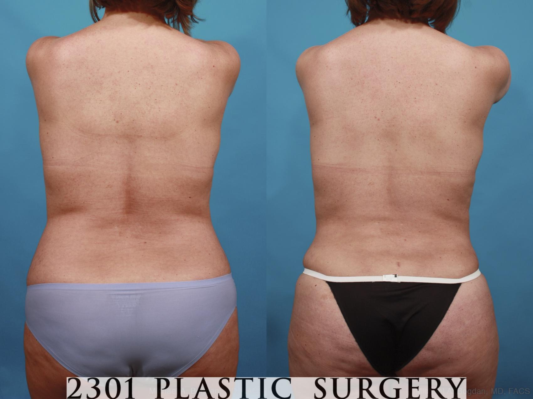 Before & After Mommy Makeover Case 592 View #6 View in Fort Worth & Frisco, Texas