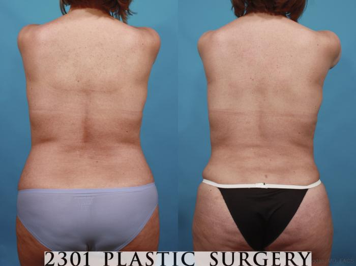 Before & After Tummy Tuck Case 592 View #6 View in Fort Worth, Plano, & Frisco, Texas
