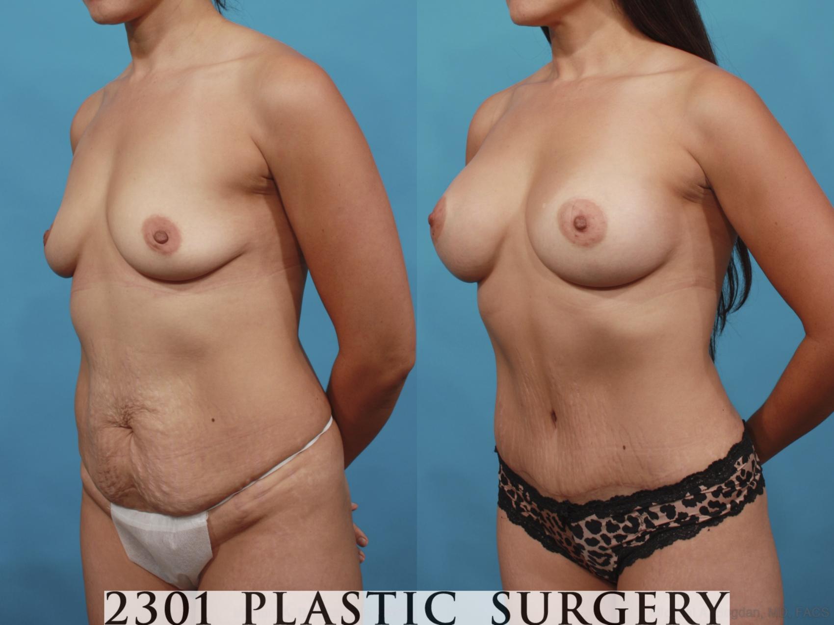 Before & After Mommy Makeover Case 593 View #2 View in Fort Worth & Frisco, Texas