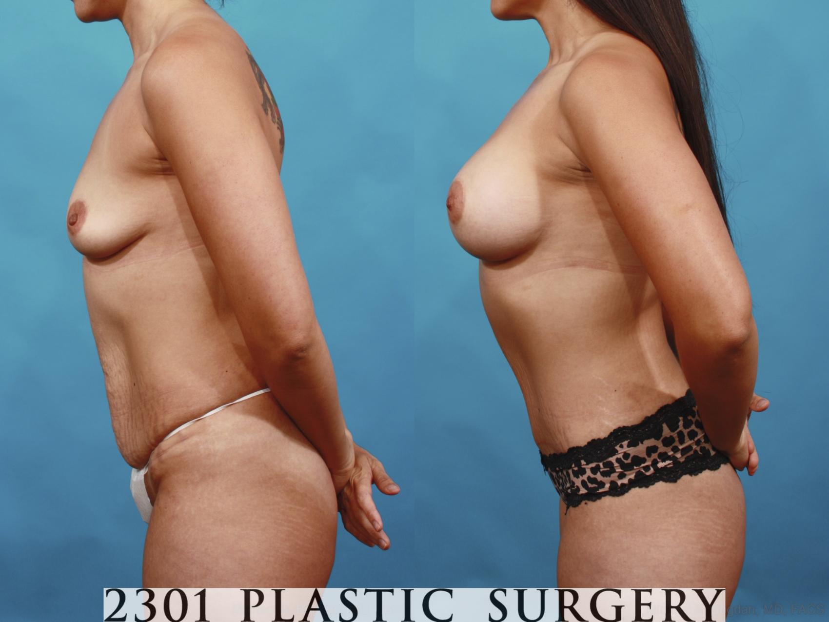 Before & After Mommy Makeover Case 593 View #3 View in Fort Worth & Frisco, Texas