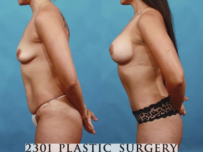 Before & After Silicone Implants Case 593 View #3 View in Fort Worth, Plano, & Frisco, Texas