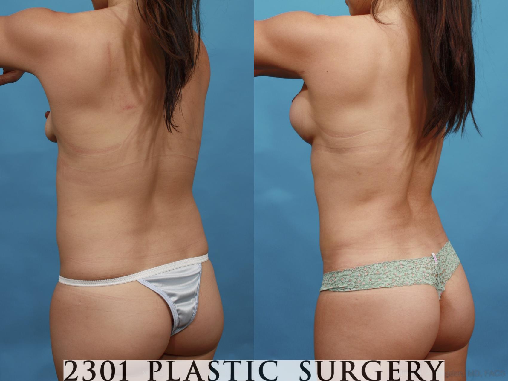 Before & After Mommy Makeover Case 594 View #4 View in Fort Worth & Frisco, Texas