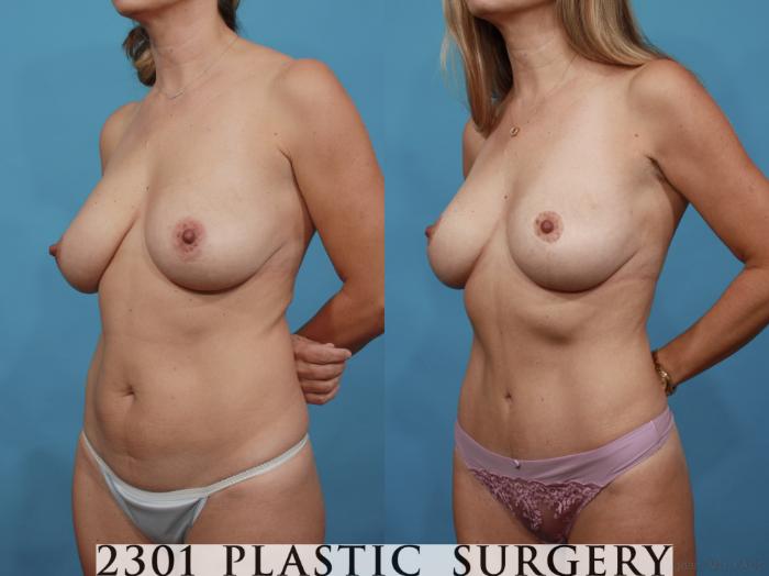 Before & After Tummy Tuck Case 595 View #2 View in Fort Worth, Plano, & Frisco, Texas