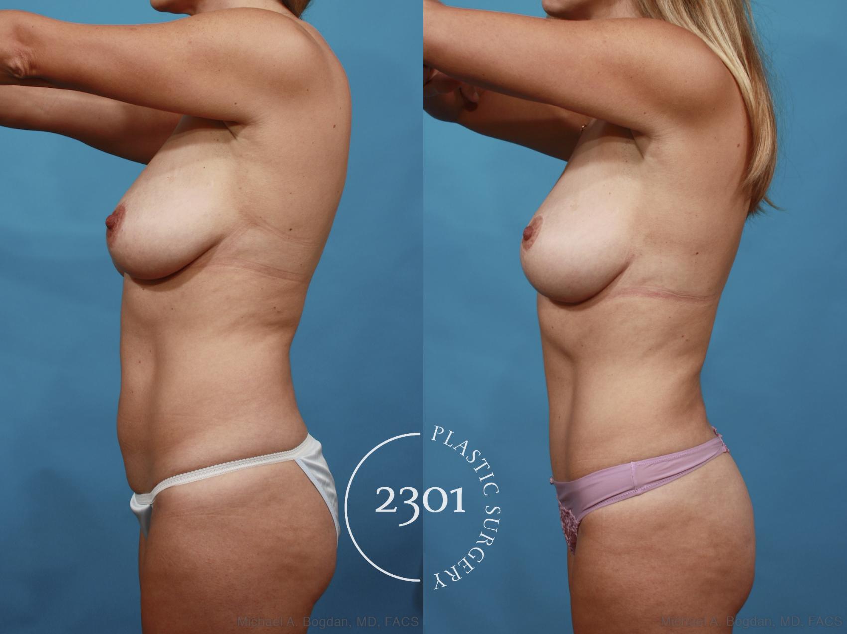 Before & After Tummy Tuck Case 595 View #3 View in Fort Worth, Plano, & Frisco, Texas