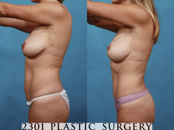 Before & After Breast Lift (Mastopexy) Case 595 View #3 View in Fort Worth, Plano, & Frisco, Texas