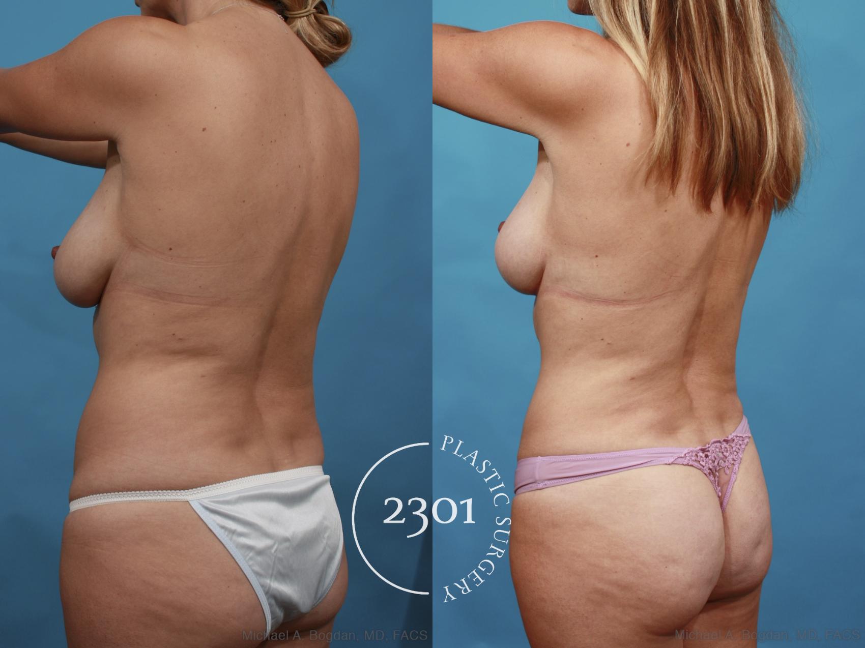 Before & After Tummy Tuck Case 595 View #4 View in Fort Worth, Plano, & Frisco, Texas