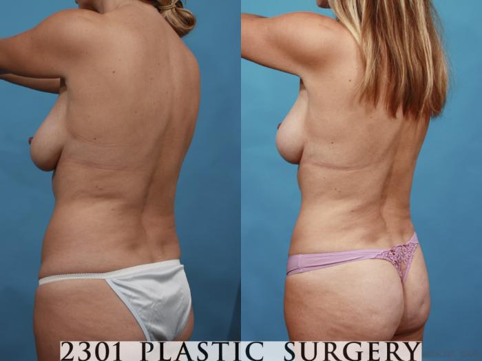 Before & After Tummy Tuck Case 595 View #4 View in Fort Worth, Plano, & Frisco, Texas
