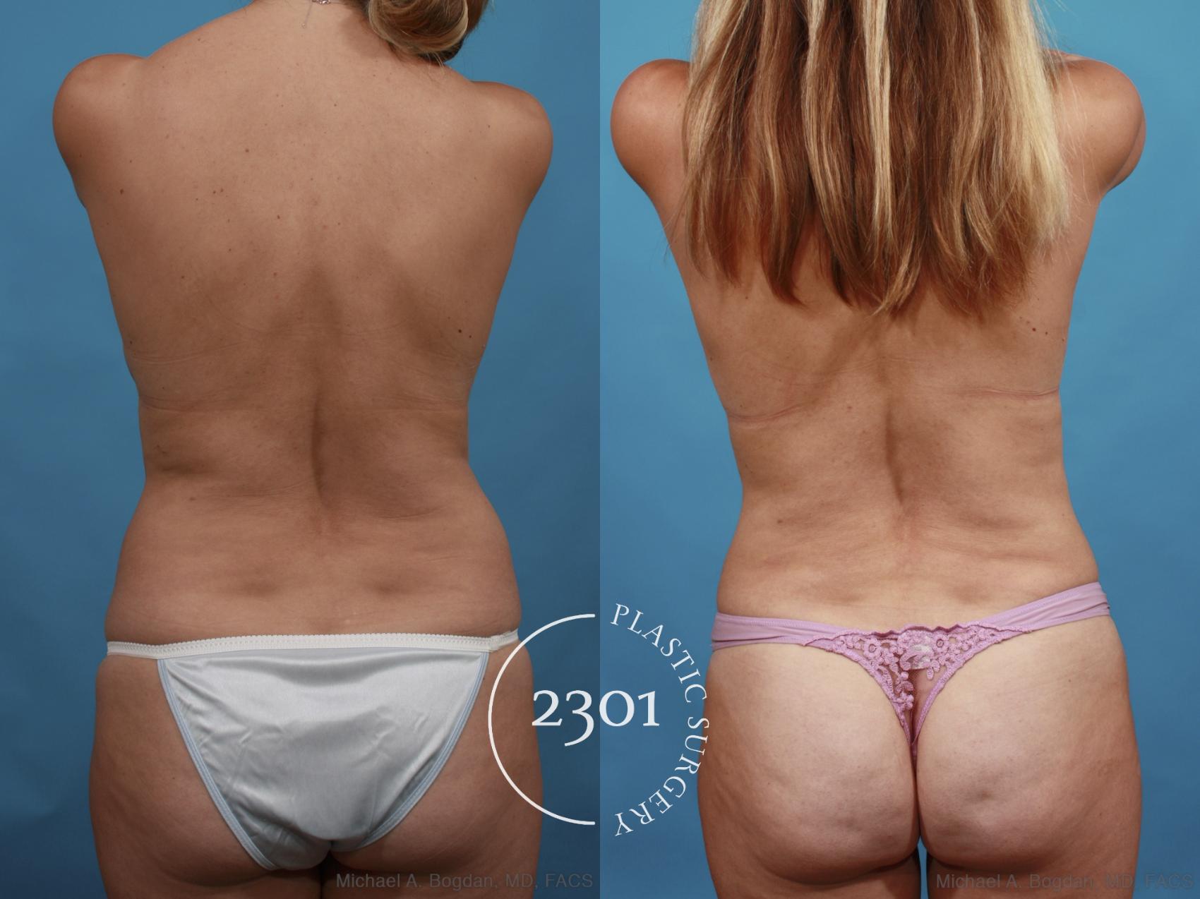 Before & After Tummy Tuck Case 595 View #5 View in Fort Worth, Plano, & Frisco, Texas
