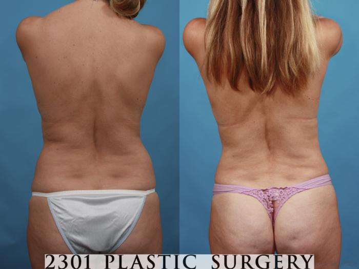 Before & After Tummy Tuck Case 595 View #5 View in Fort Worth, Plano, & Frisco, Texas
