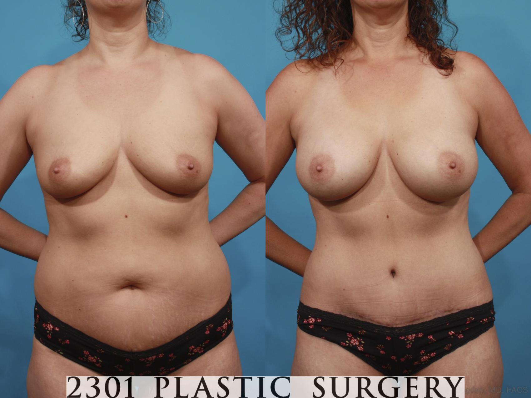 Before & After Breast Augmentation Case 598 View #1 View in Fort Worth & Frisco, Texas
