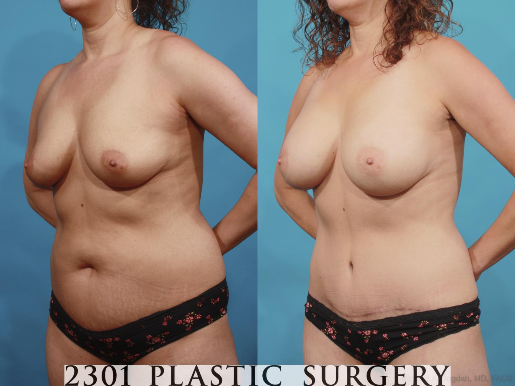 Before & After Mommy Makeover Case 598 View #2 View in Fort Worth & Frisco, Texas