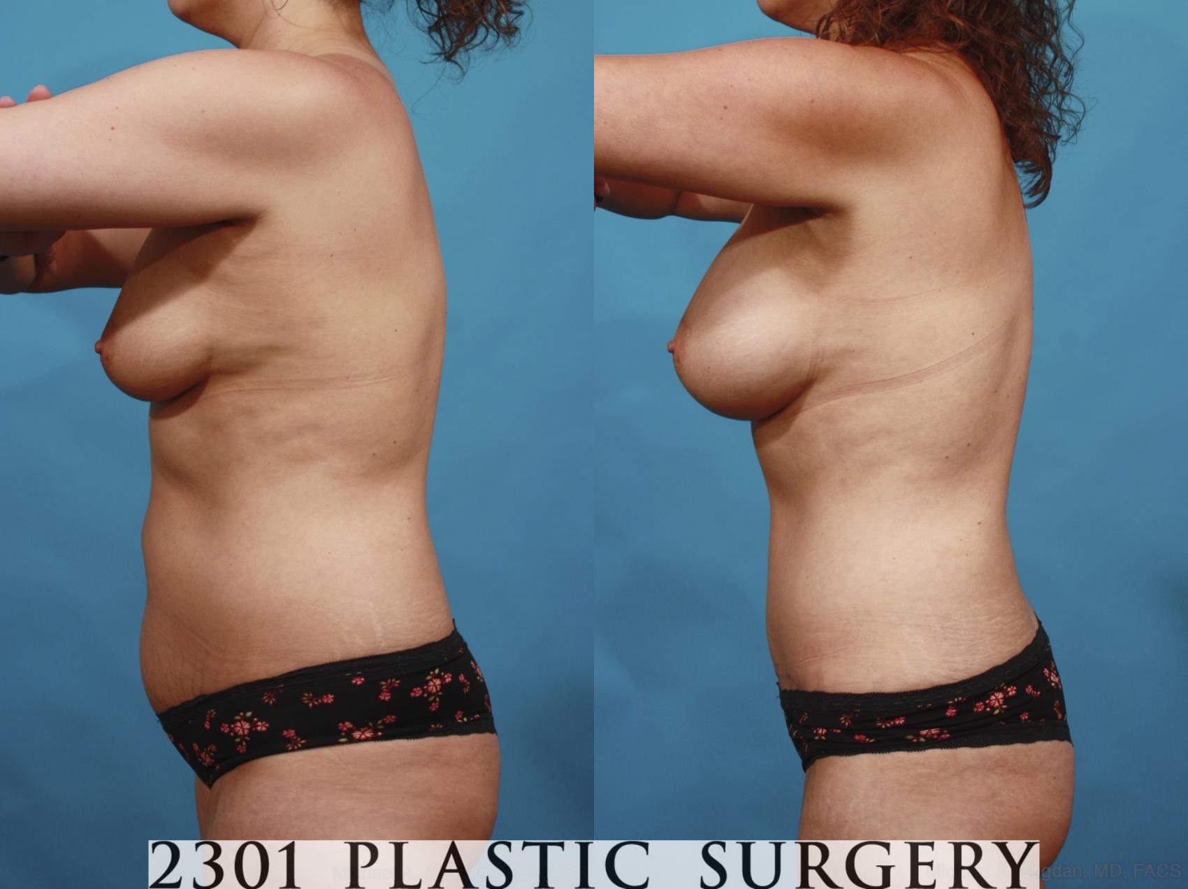 Before & After Mommy Makeover Case 598 View #3 View in Fort Worth & Frisco, Texas