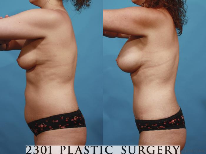 Before & After Silicone Implants Case 598 View #3 View in Fort Worth, Plano, & Frisco, Texas