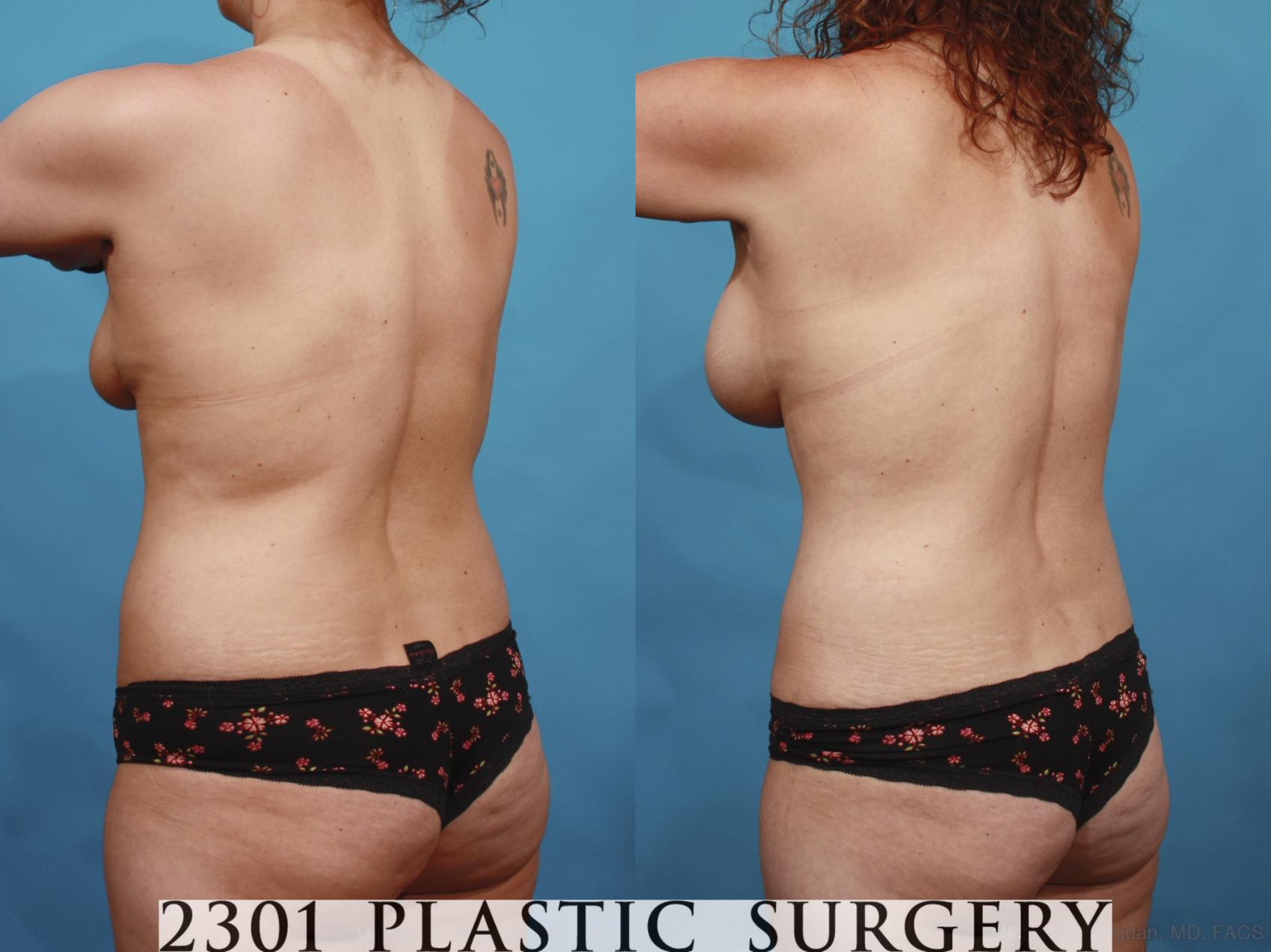 Before & After Mommy Makeover Case 598 View #4 View in Fort Worth & Frisco, Texas