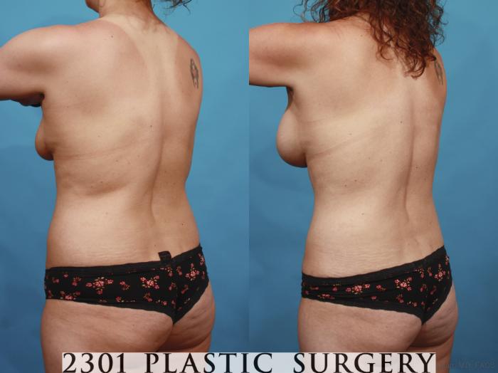 Before & After Silicone Implants Case 598 View #4 View in Fort Worth, Plano, & Frisco, Texas