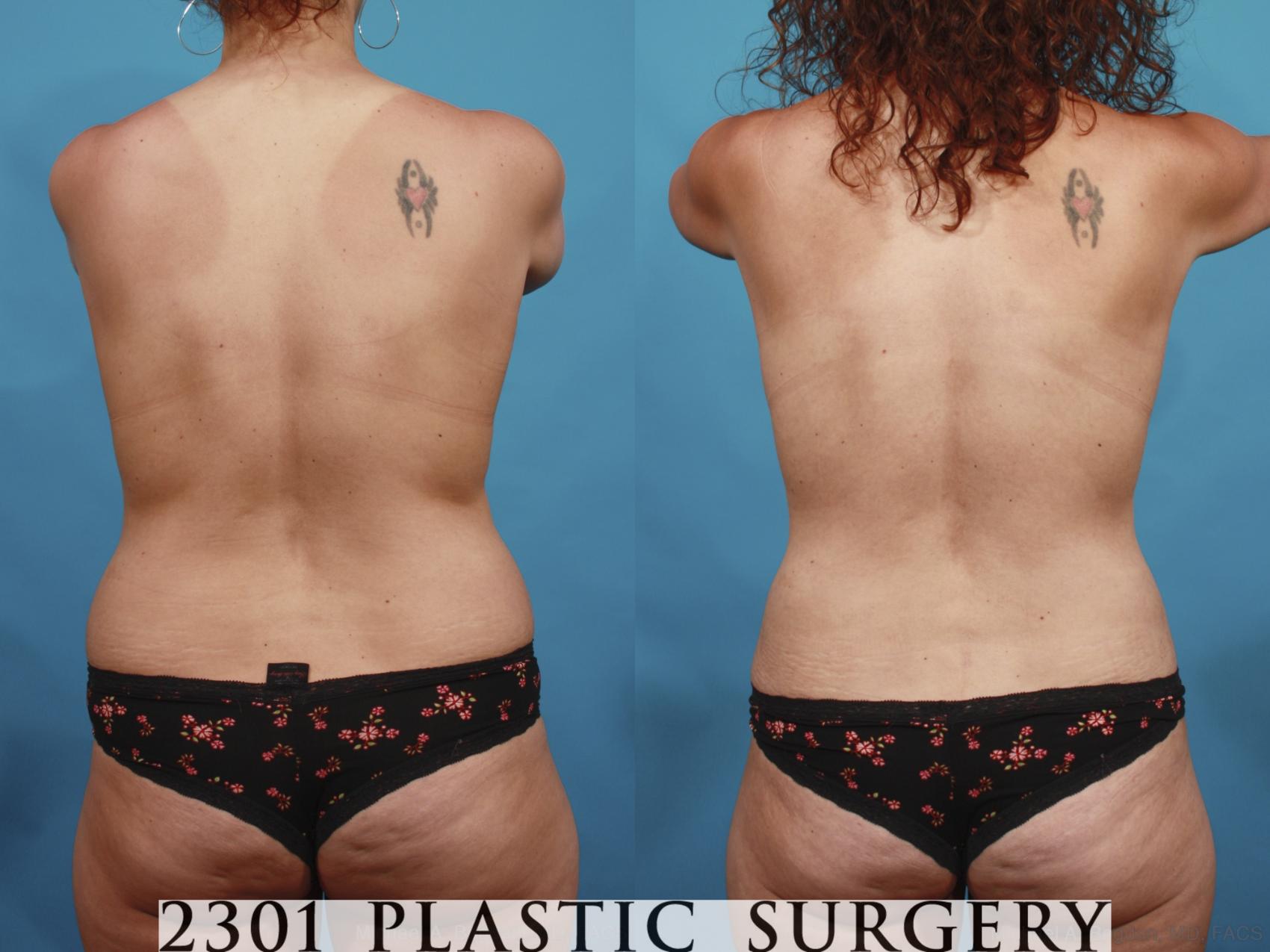 Before & After Mommy Makeover Case 598 View #5 View in Fort Worth & Frisco, Texas