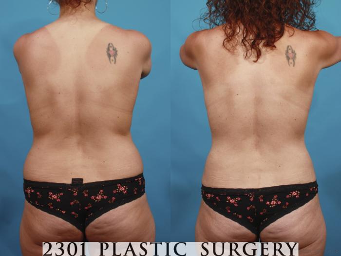 Before & After Tummy Tuck Case 598 View #5 View in Fort Worth, Plano, & Frisco, Texas