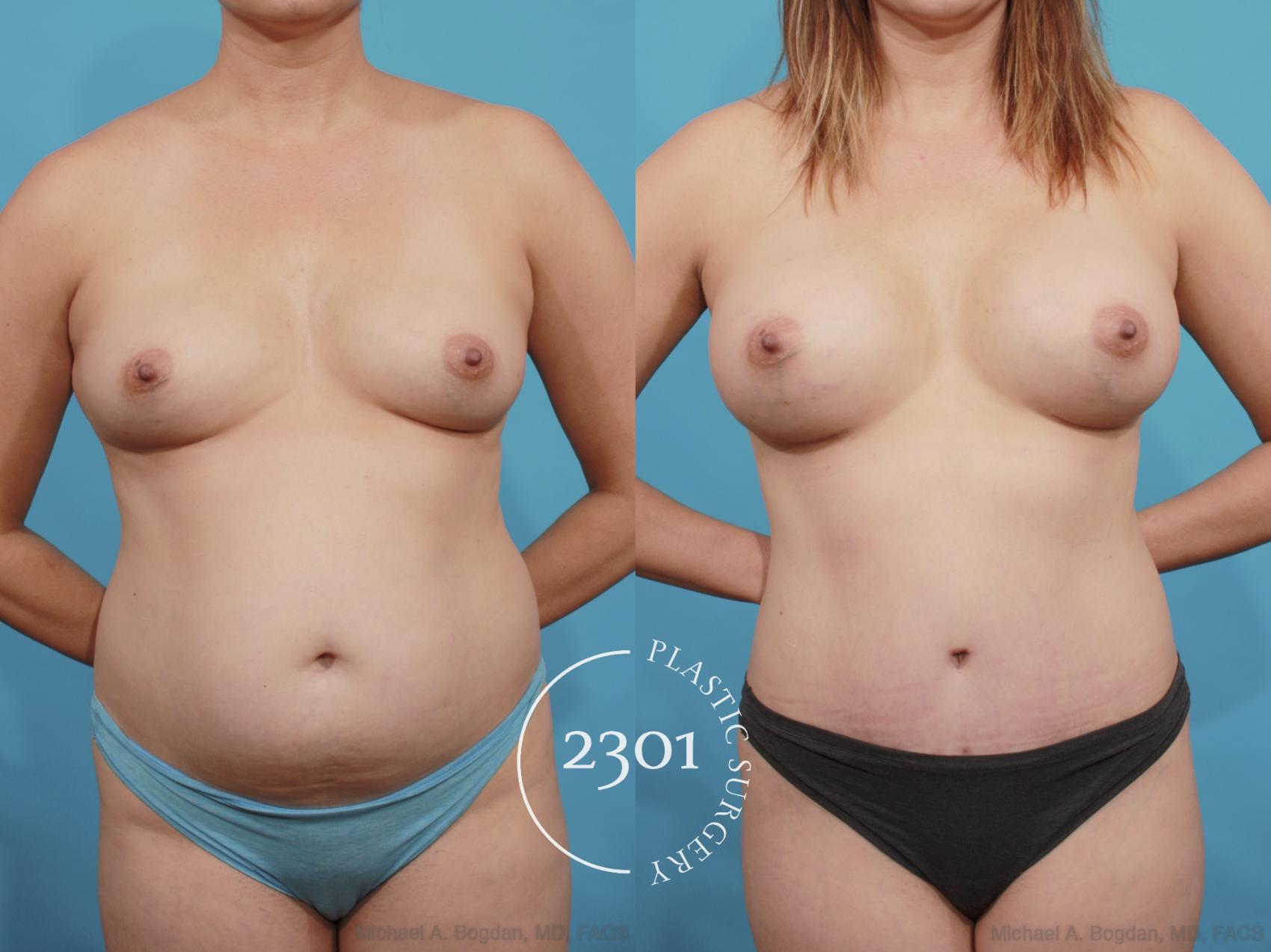 Before & After Tummy Tuck Case 599 View #1 View in Fort Worth, Plano, & Frisco, Texas