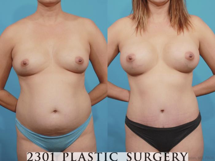 Before & After Silicone Implants Case 599 View #1 View in Fort Worth, Plano, & Frisco, Texas
