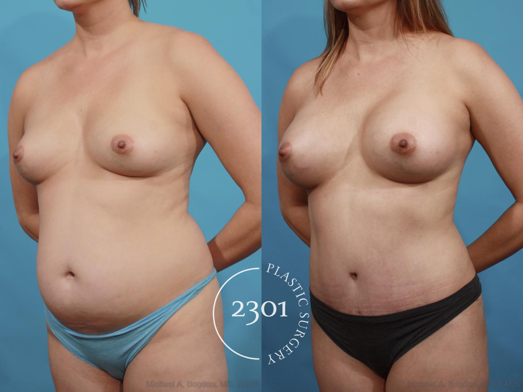 Before & After Tummy Tuck Case 599 View #2 View in Fort Worth, Plano, & Frisco, Texas
