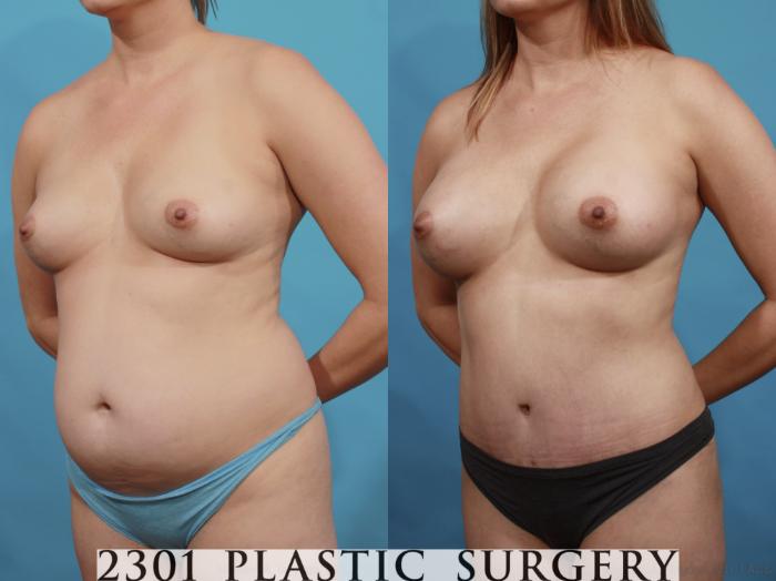 Before & After Silicone Implants Case 599 View #2 View in Fort Worth, Plano, & Frisco, Texas