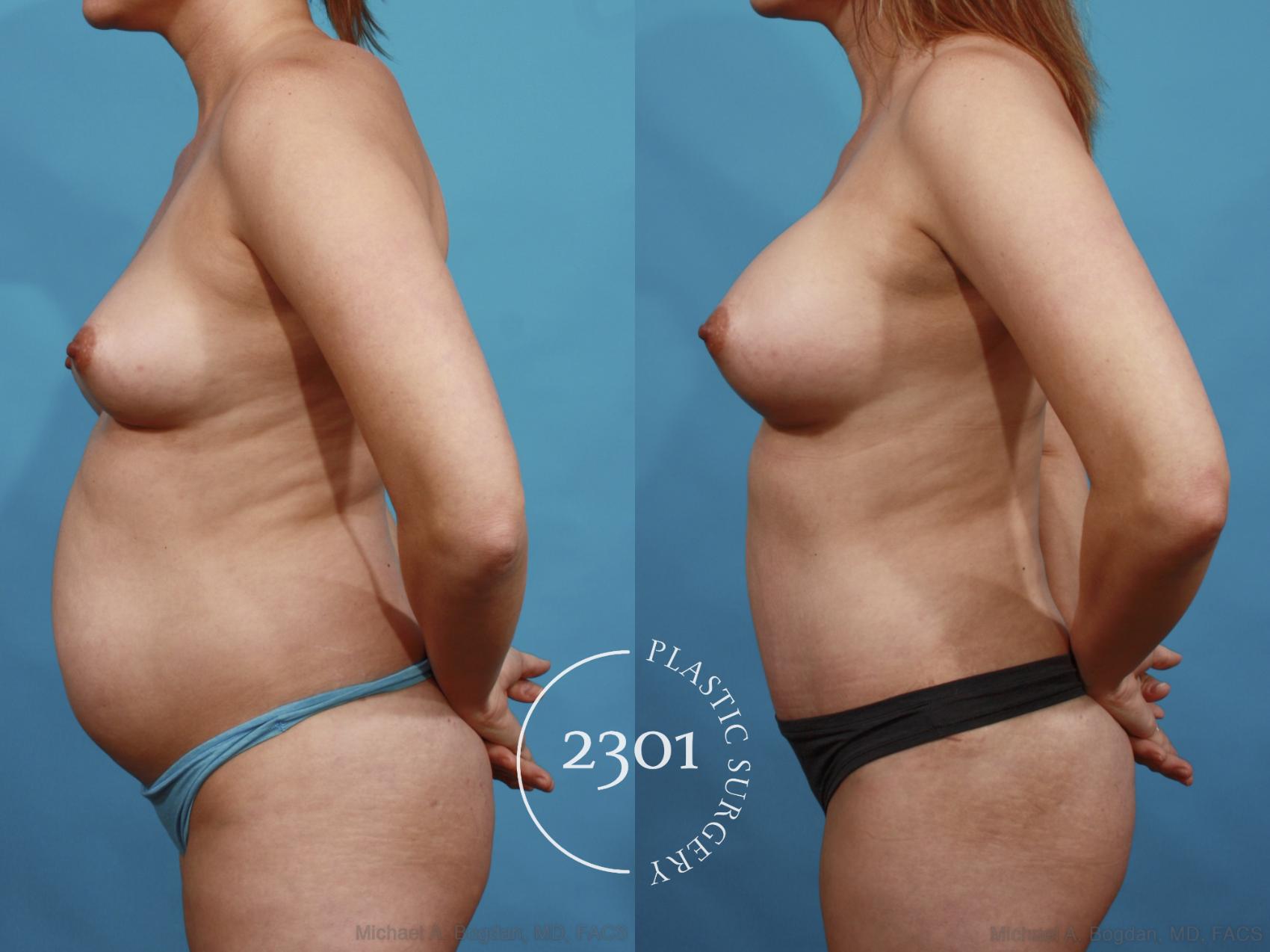 Before & After Tummy Tuck Case 599 View #3 View in Fort Worth, Plano, & Frisco, Texas