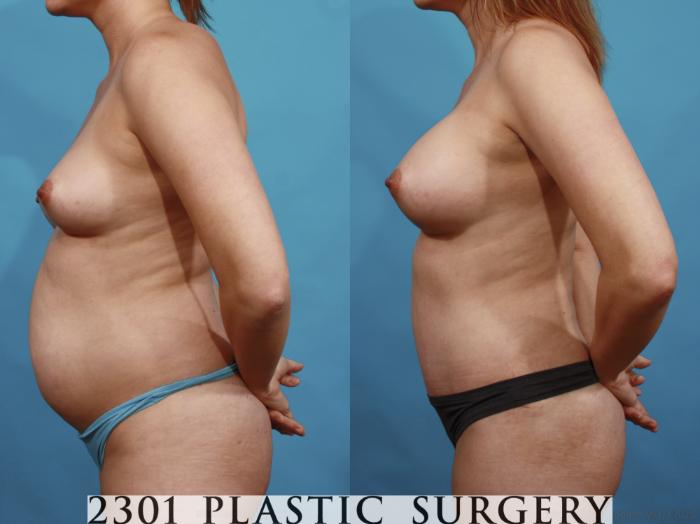 Before & After Silicone Implants Case 599 View #3 View in Fort Worth, Plano, & Frisco, Texas