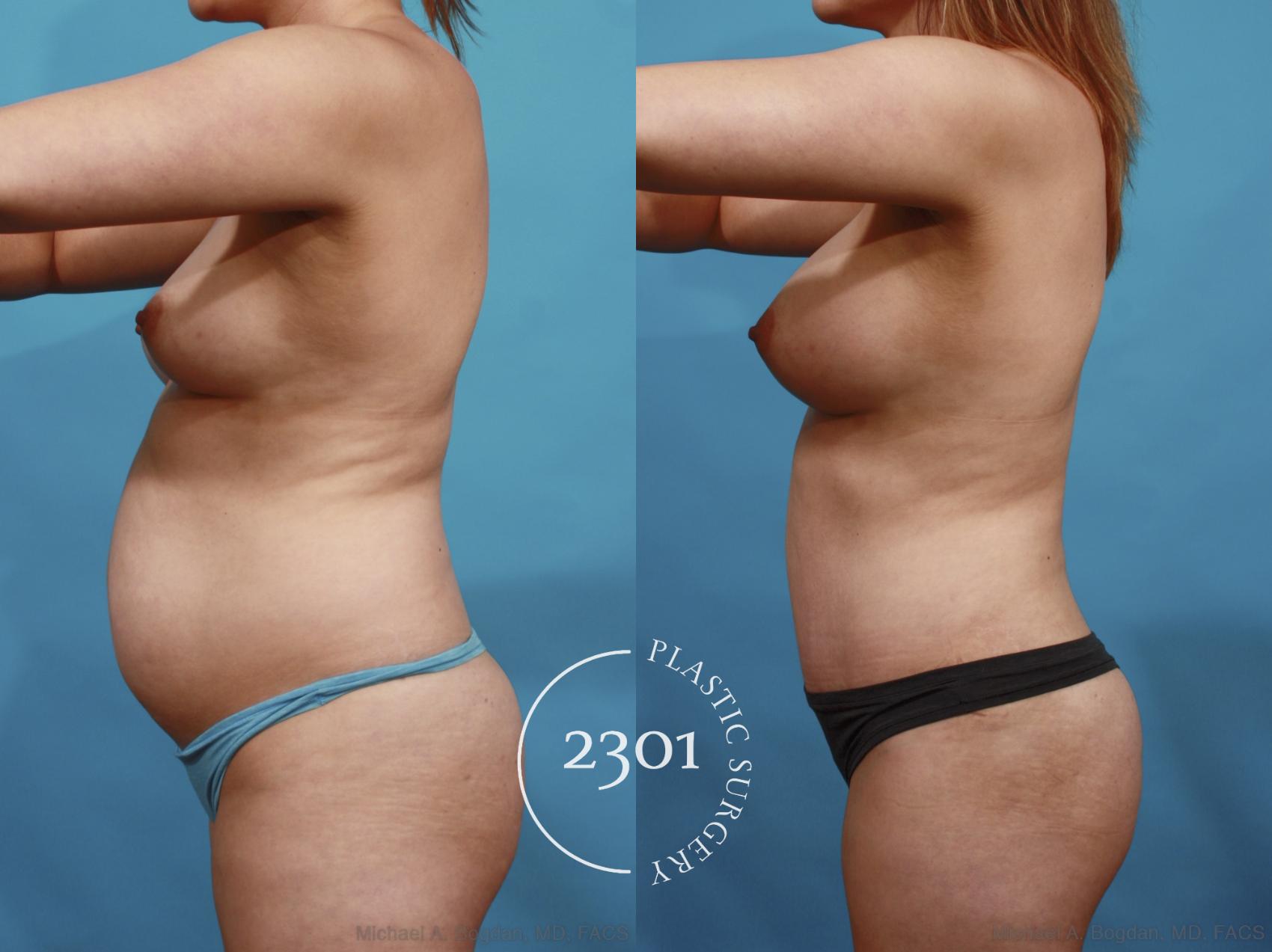 Before & After Tummy Tuck Case 599 View #4 View in Fort Worth, Plano, & Frisco, Texas