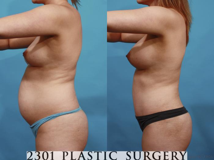Before & After Mommy Makeover Case 599 View #4 View in Fort Worth, Plano, & Frisco, Texas