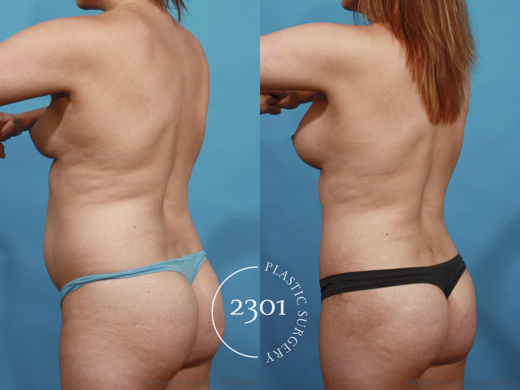 Before & After Tummy Tuck Case 599 View #5 View in Fort Worth, Plano, & Frisco, Texas