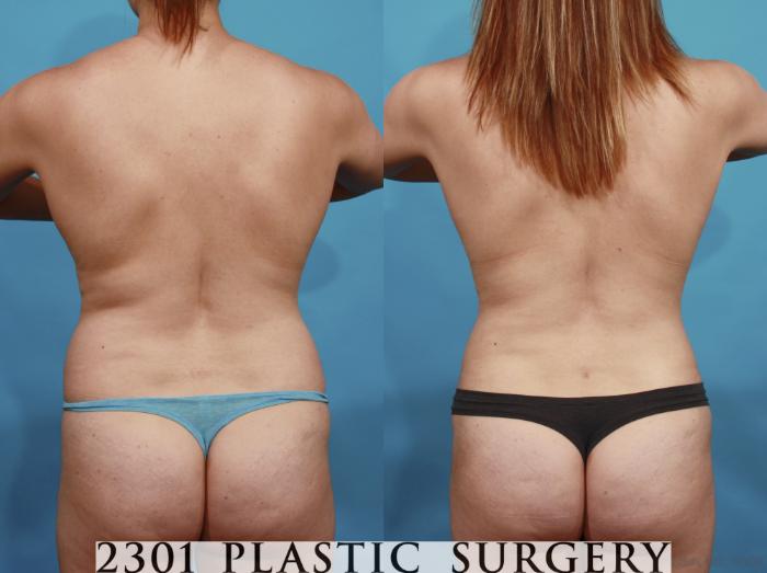 Before & After Silicone Implants Case 599 View #6 View in Fort Worth, Plano, & Frisco, Texas