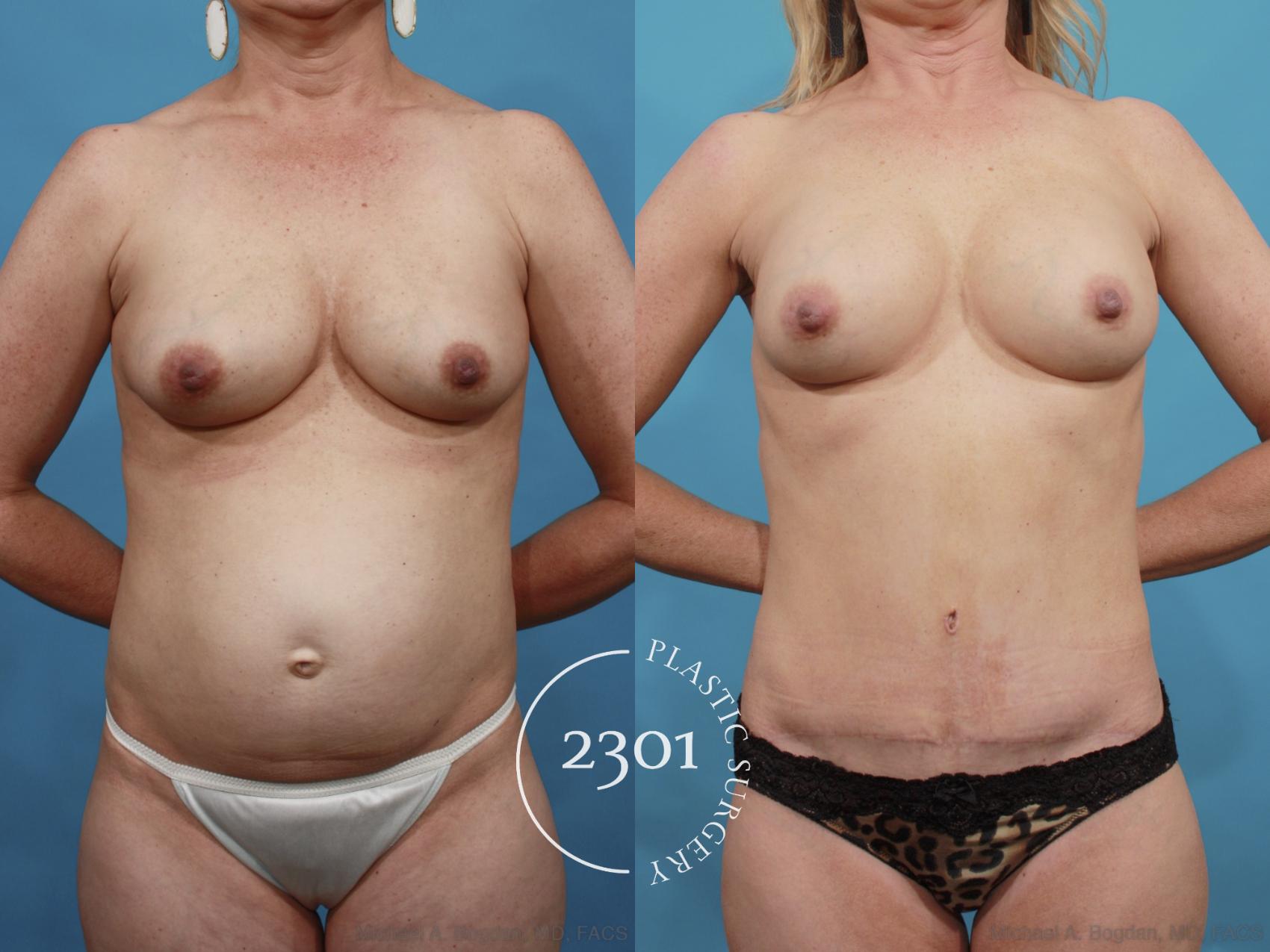 Before & After Tummy Tuck Case 600 View #1 View in Fort Worth, Plano, & Frisco, Texas