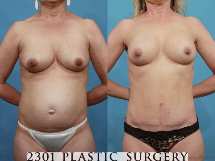Before & After Silicone Implants Case 600 View #1 View in Fort Worth, Plano, & Frisco, Texas