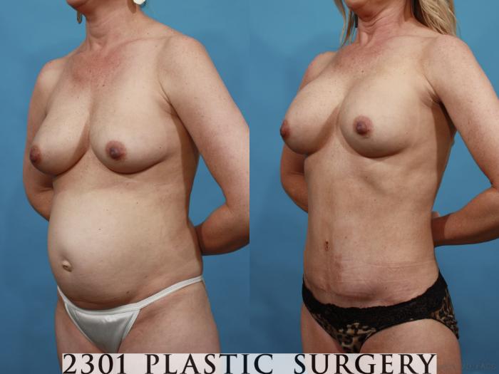 Before & After Silicone Implants Case 600 View #2 View in Fort Worth, Plano, & Frisco, Texas