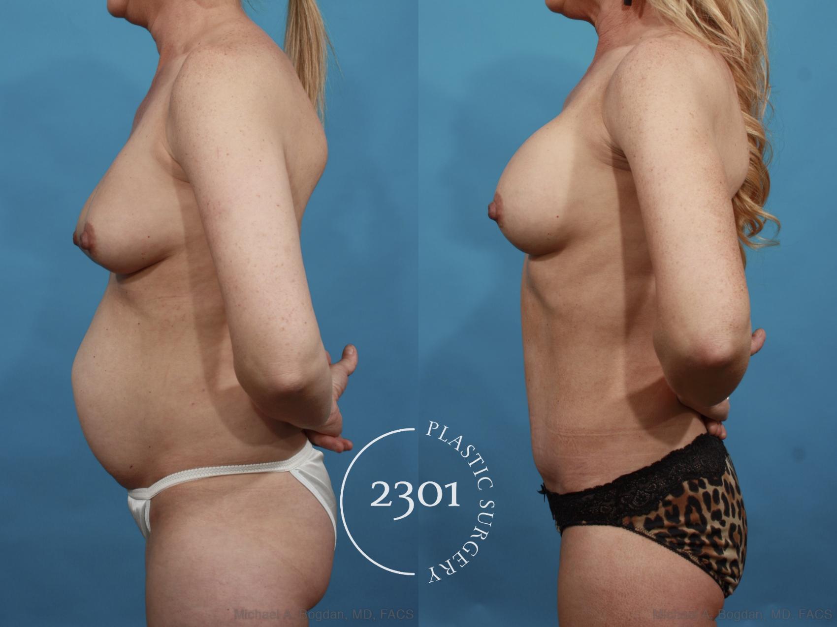 Before & After Breast Augmentation Revision Case 600 View #3 View in Fort Worth, Plano, & Frisco, Texas