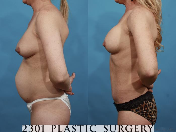 Before & After Silicone Implants Case 600 View #3 View in Fort Worth, Plano, & Frisco, Texas