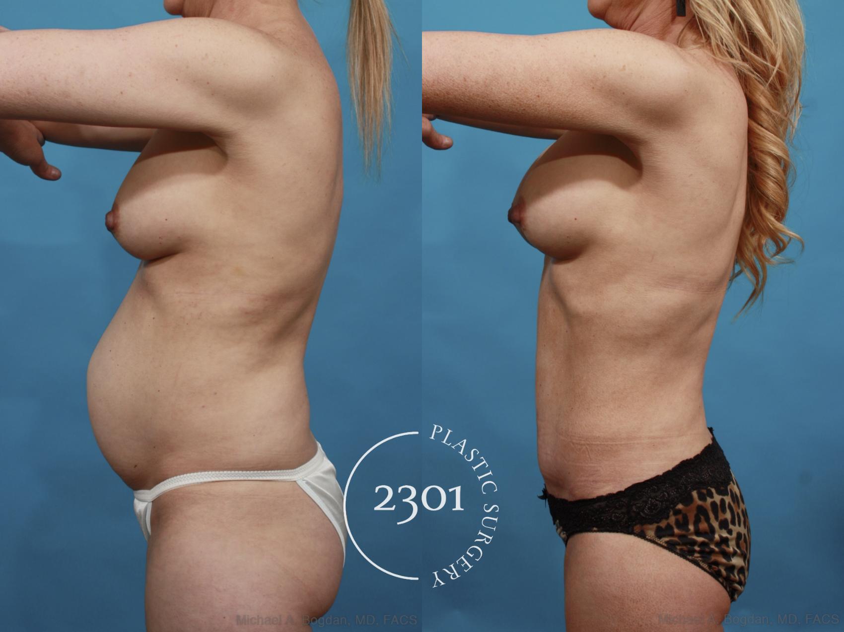Before & After Breast Augmentation Revision Case 600 View #4 View in Fort Worth, Plano, & Frisco, Texas